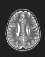 Leucomalacia Periventricular Neuropedwikia