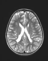 Leucomalacia Periventricular Neuropedwikia